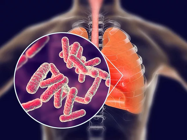 La tuberculosis volvió: pobreza, abandono y una bacteria que nunca desapareció