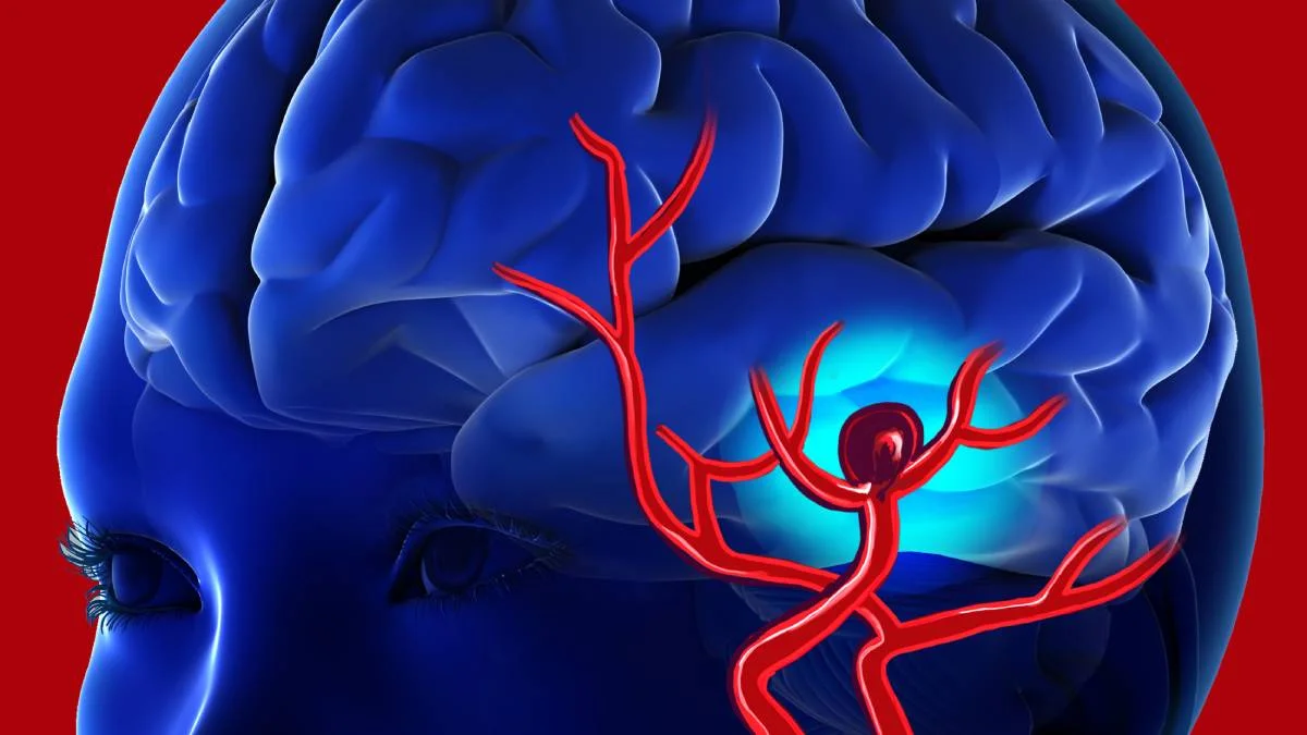 Córdoba logró un hito médico con una técnica inédita para tratar aneurismas cerebrales