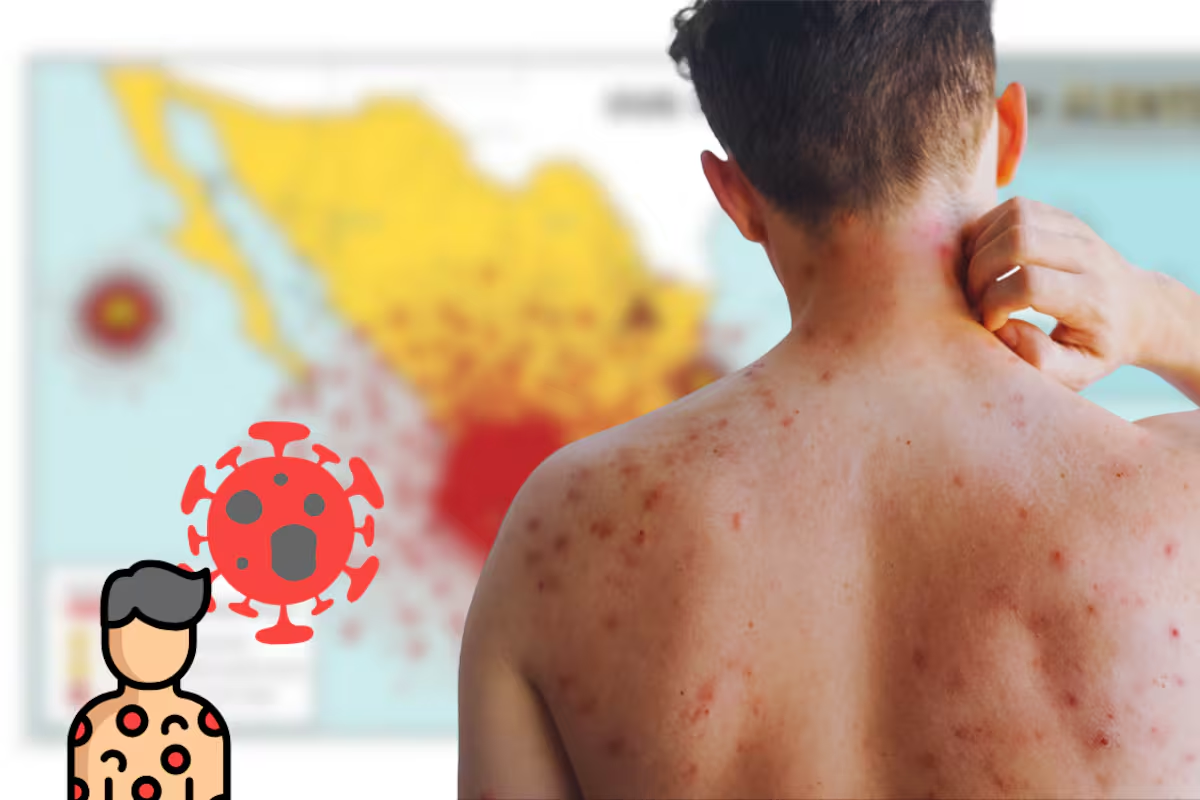 El regreso del Mundial enciende la alerta por sarampión: Salud advierte sobre el riesgo de reintroducción del virus
